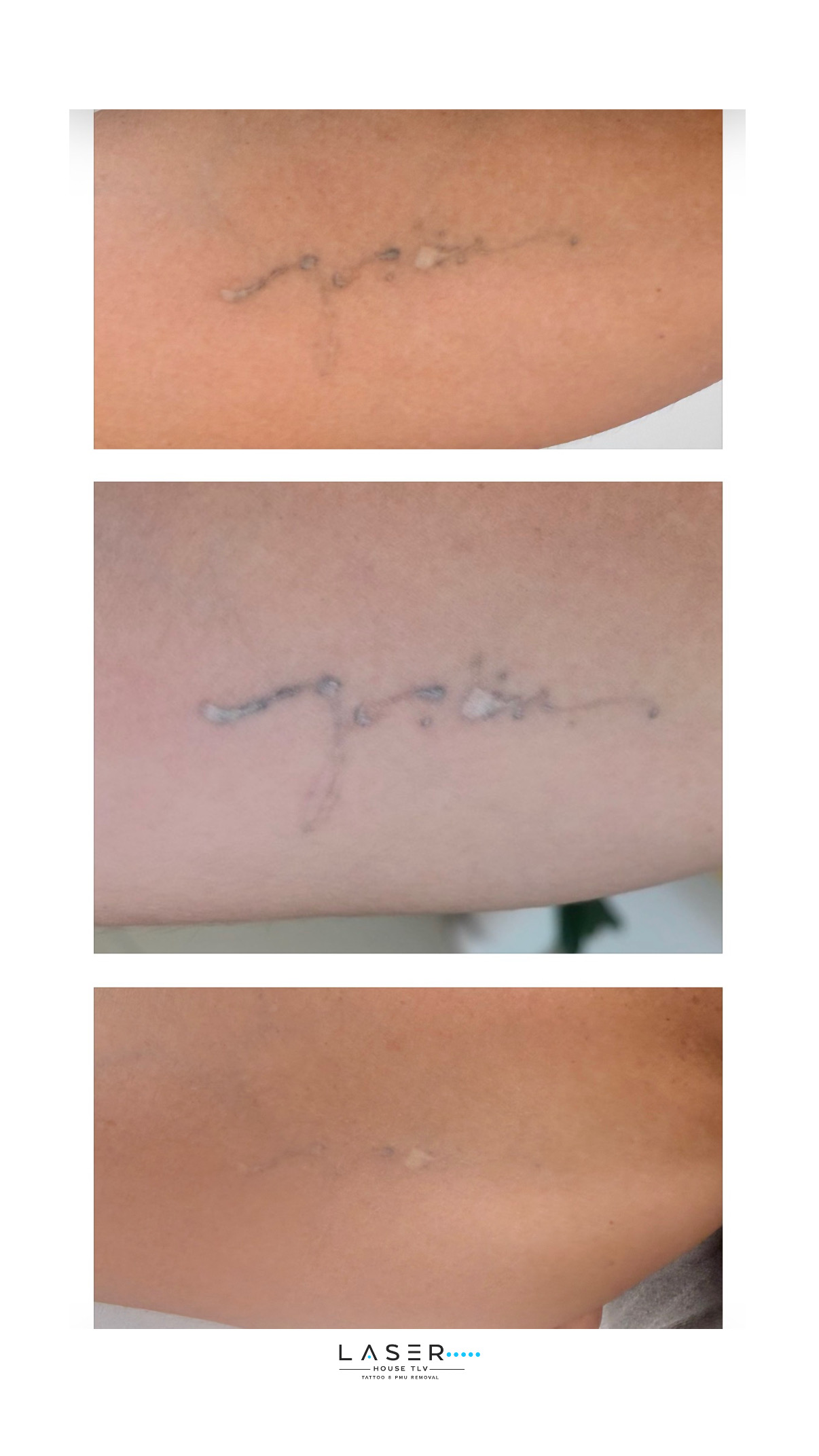 SCARS FRACTIONAL LASER