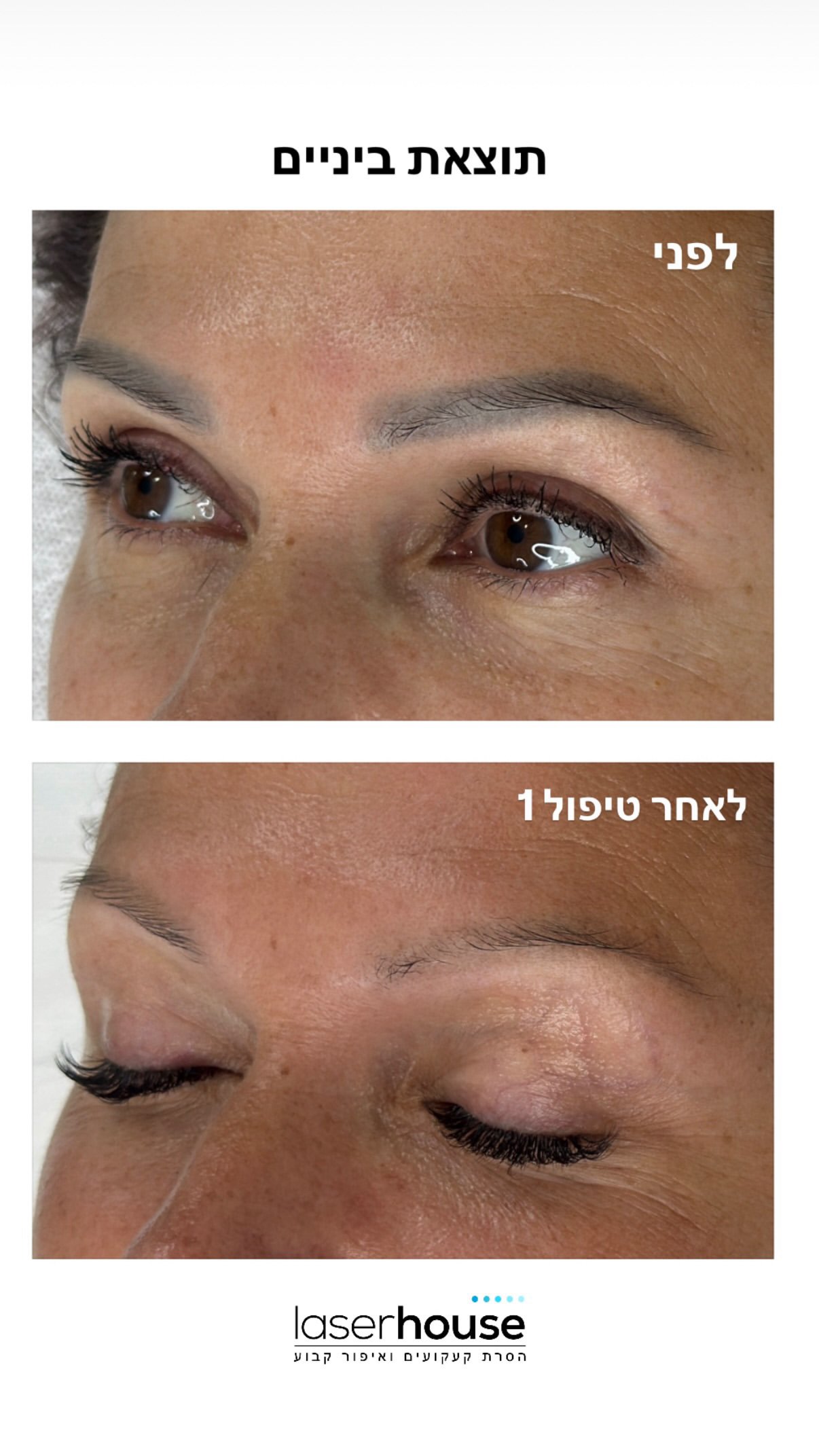 הסרת איפור קבוע בגבות