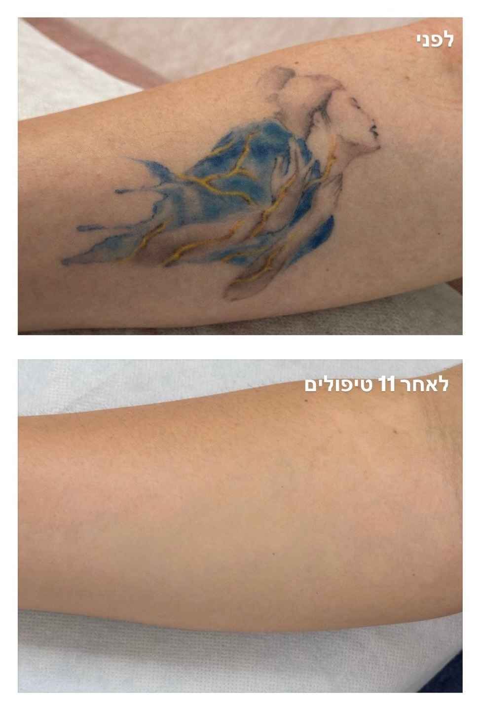 beforeanddaftertattoocolor