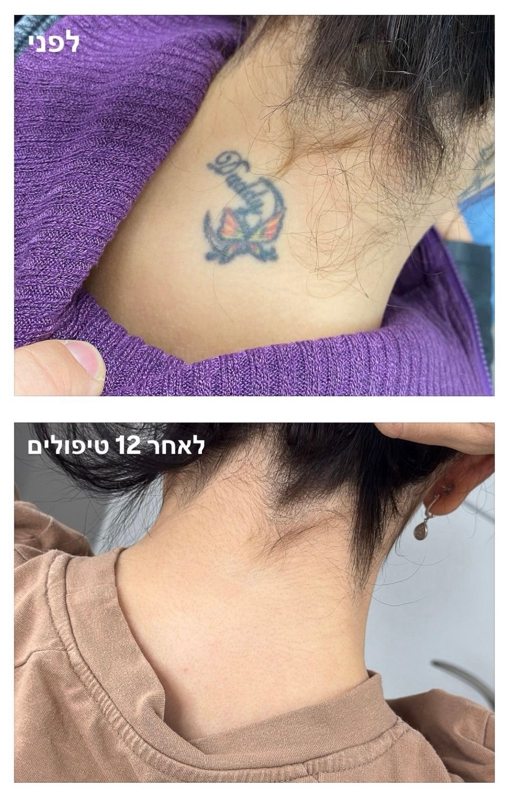 color tattoo removal laser house