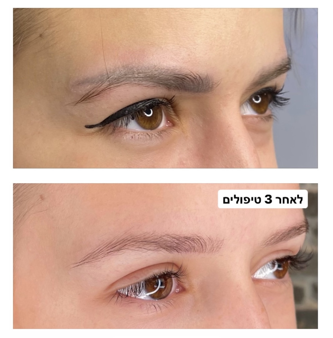הסרת איפור קבוע בלייזר