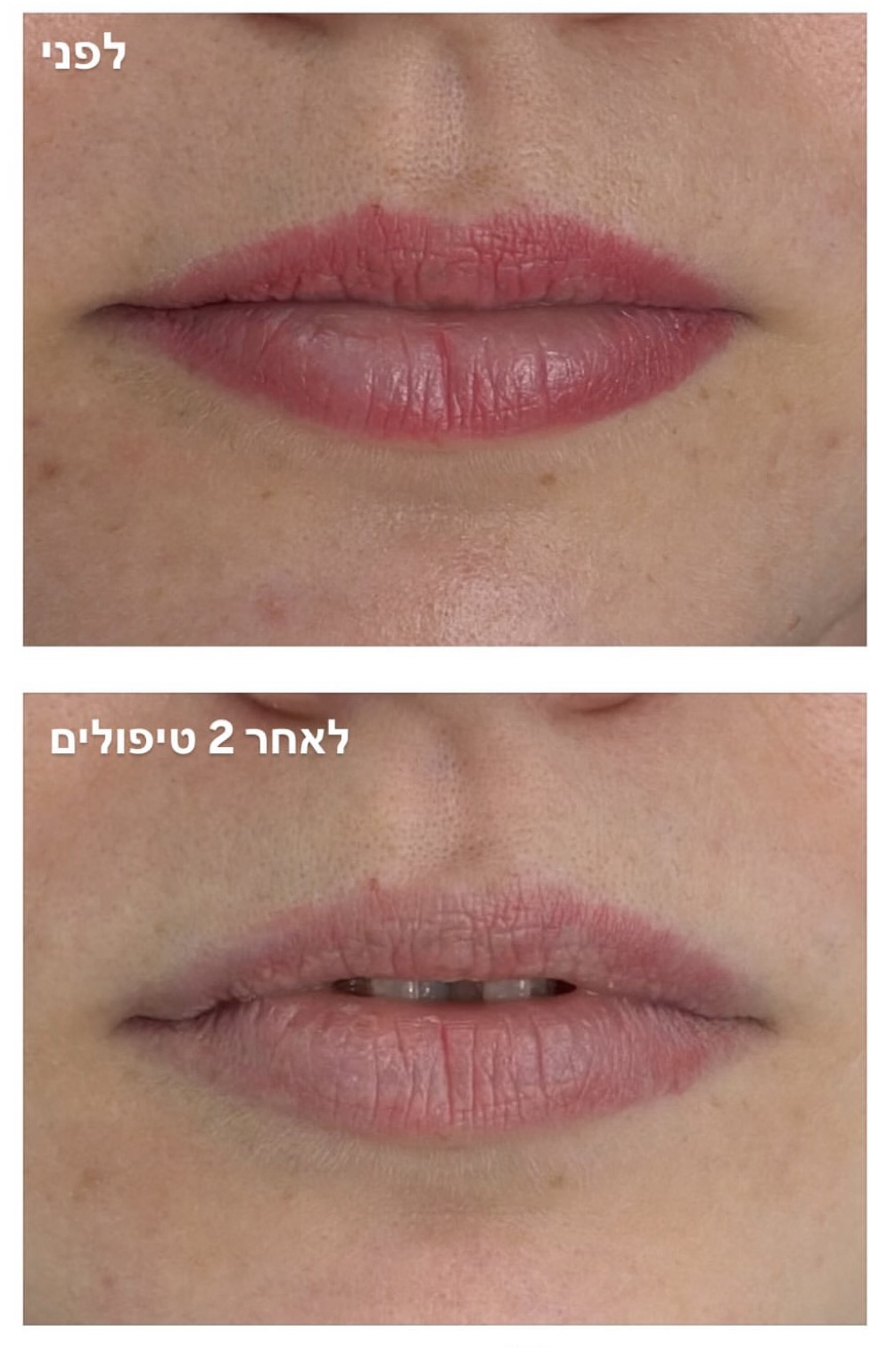 pmu removal lips