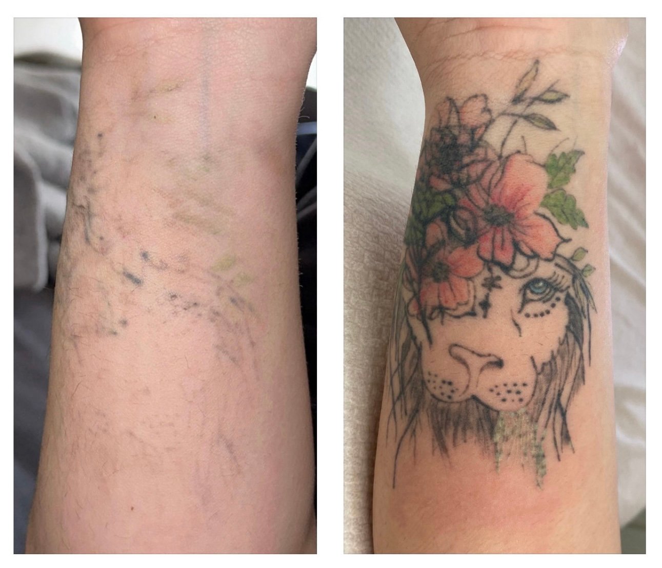 color tattoo removal prosess