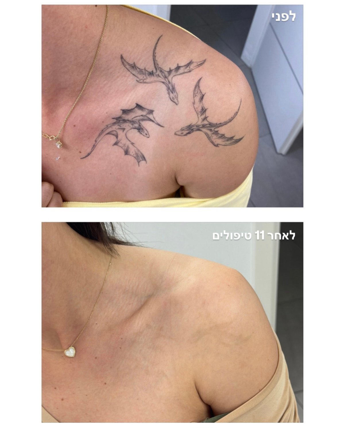 tattoo removal process