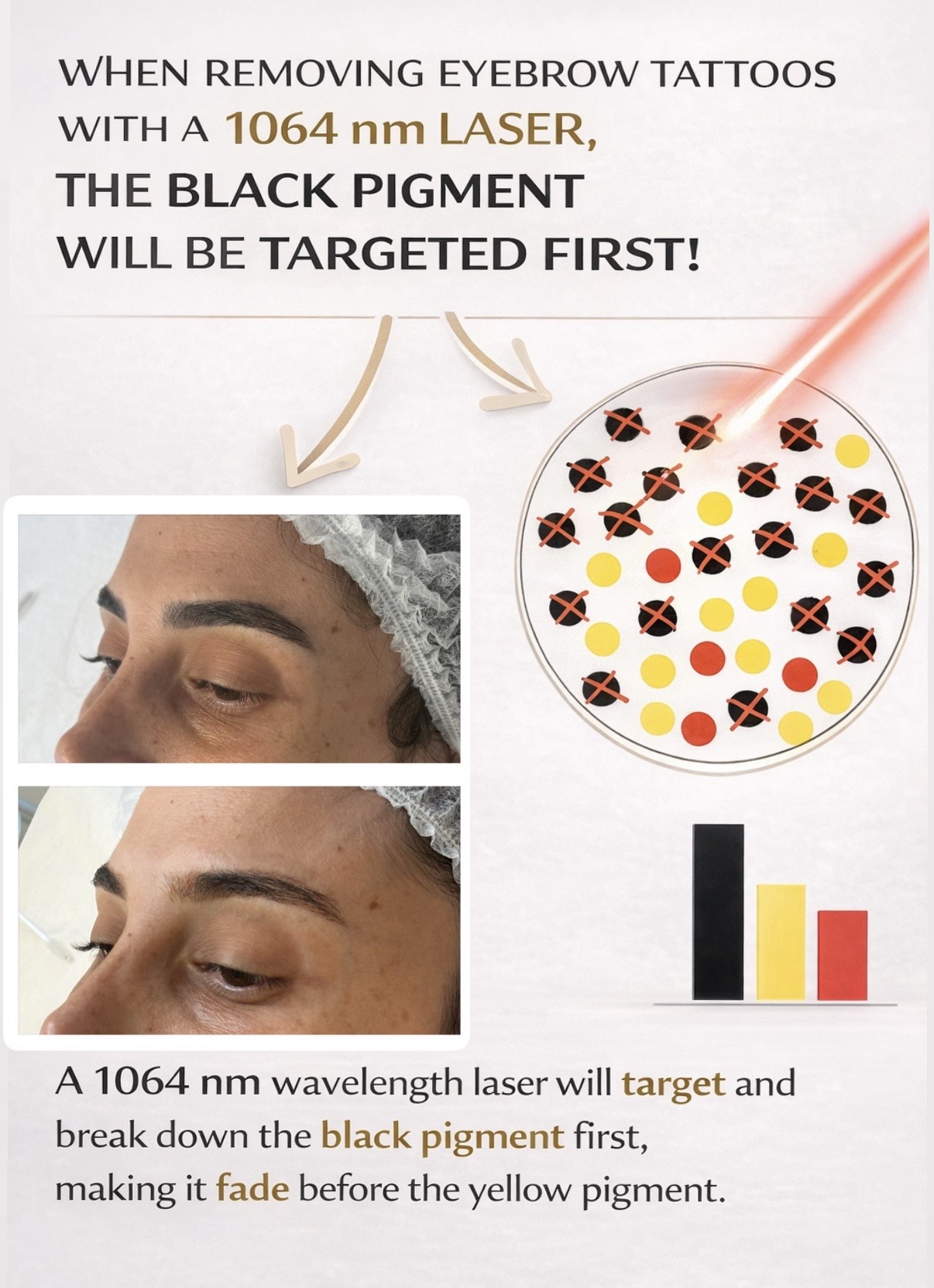 pigment-pmu-removal