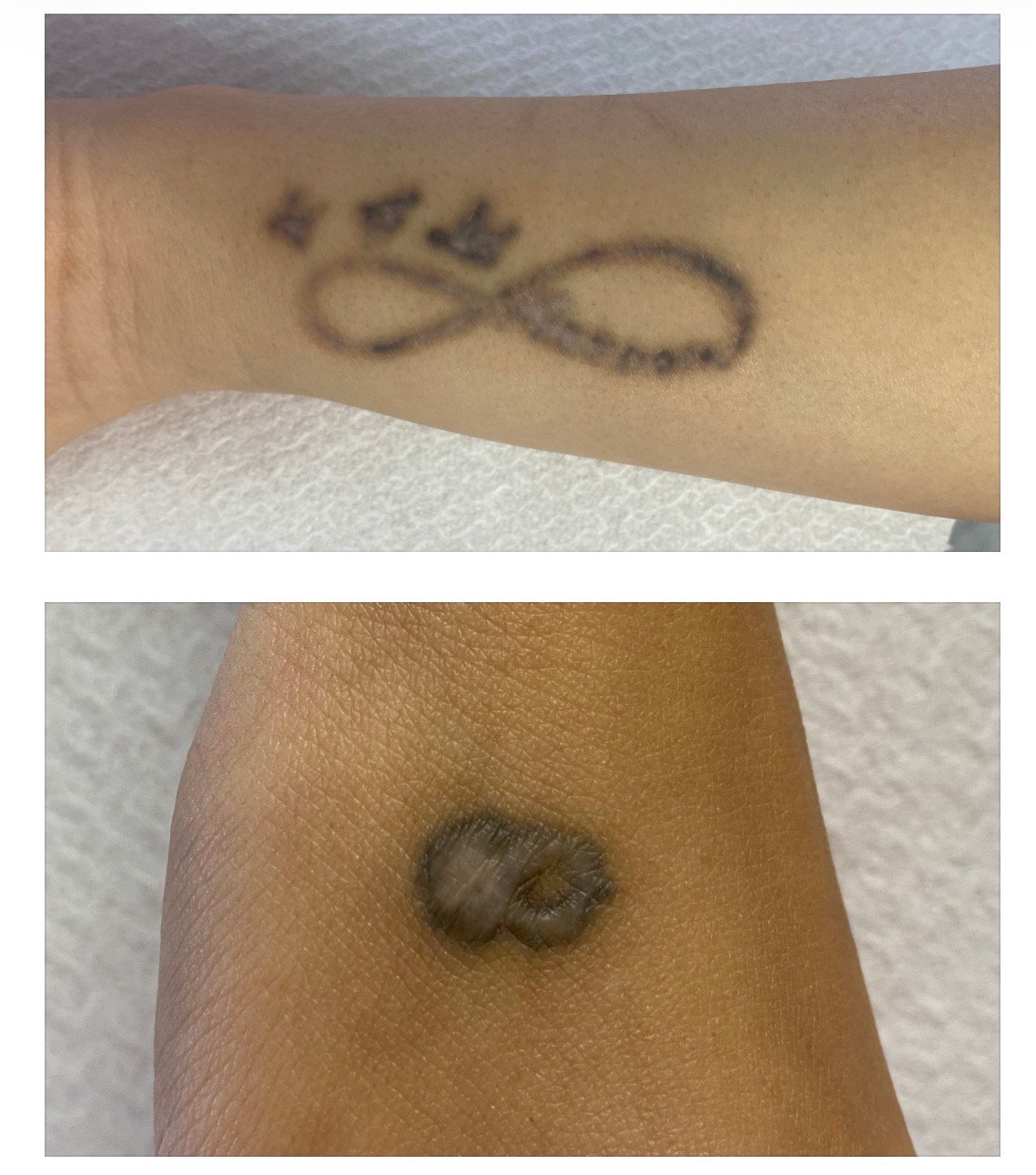 scars after not professional tattoo removal