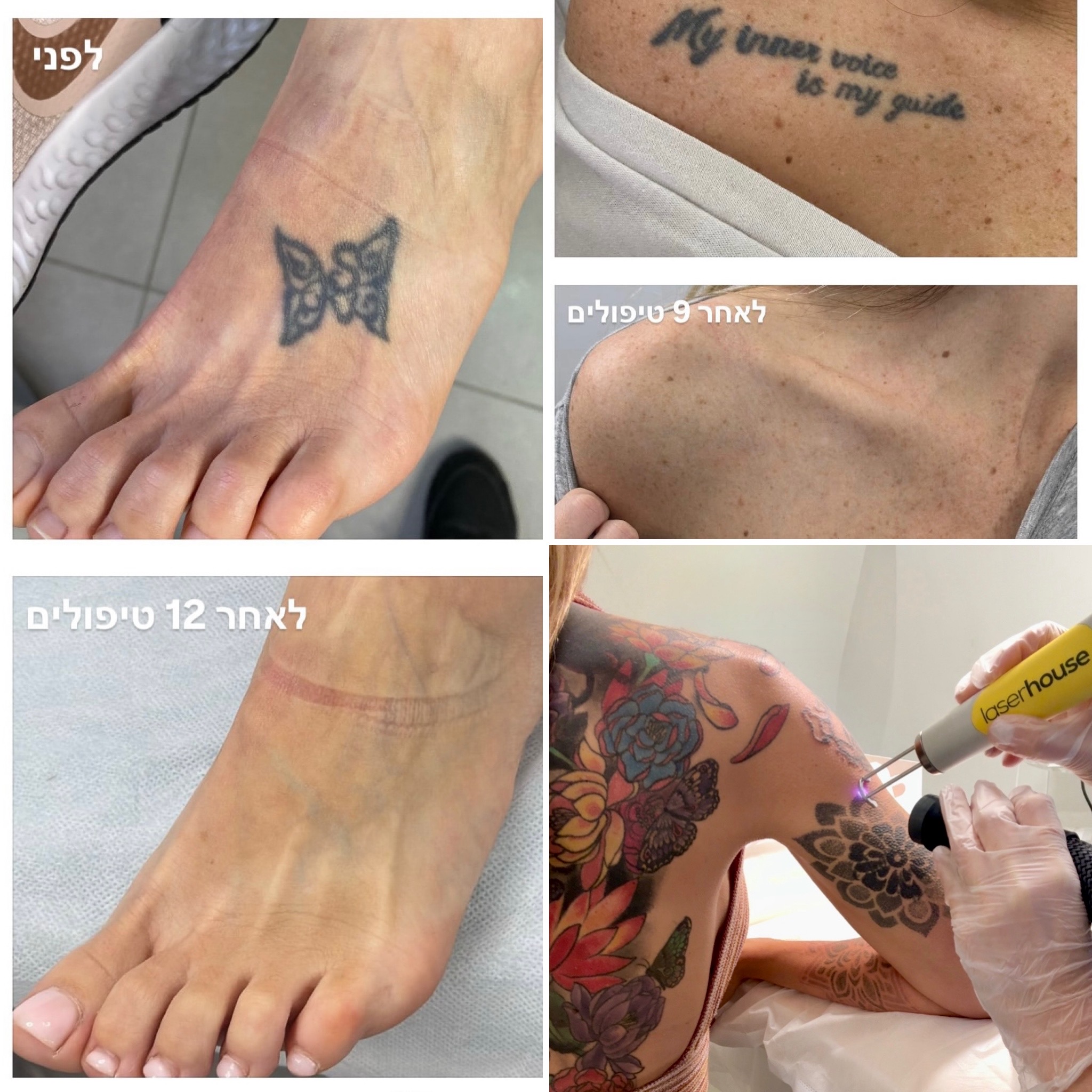 reculs-tattoo-removal-bebore-ana-after-laser-house