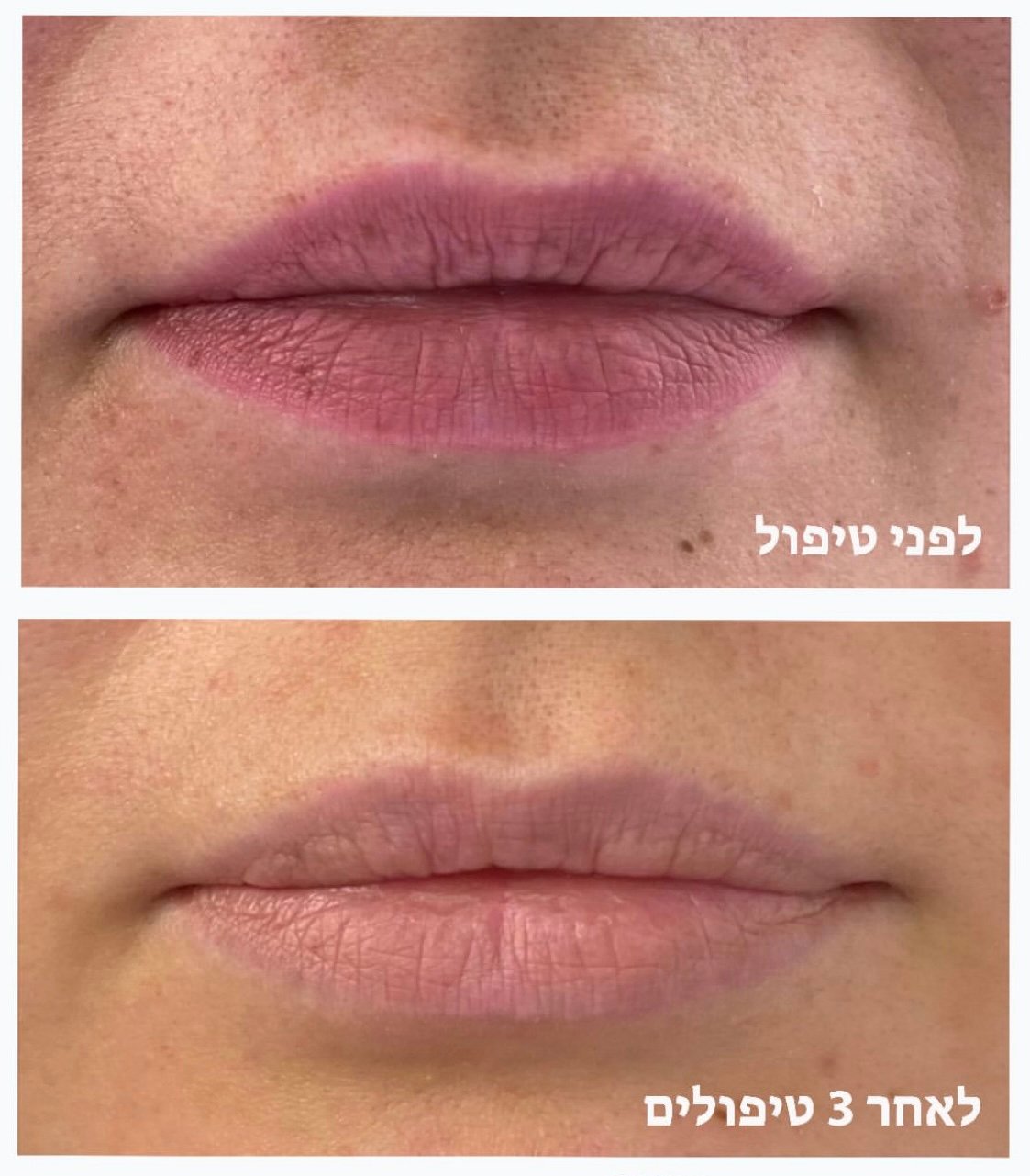 pmu lips
