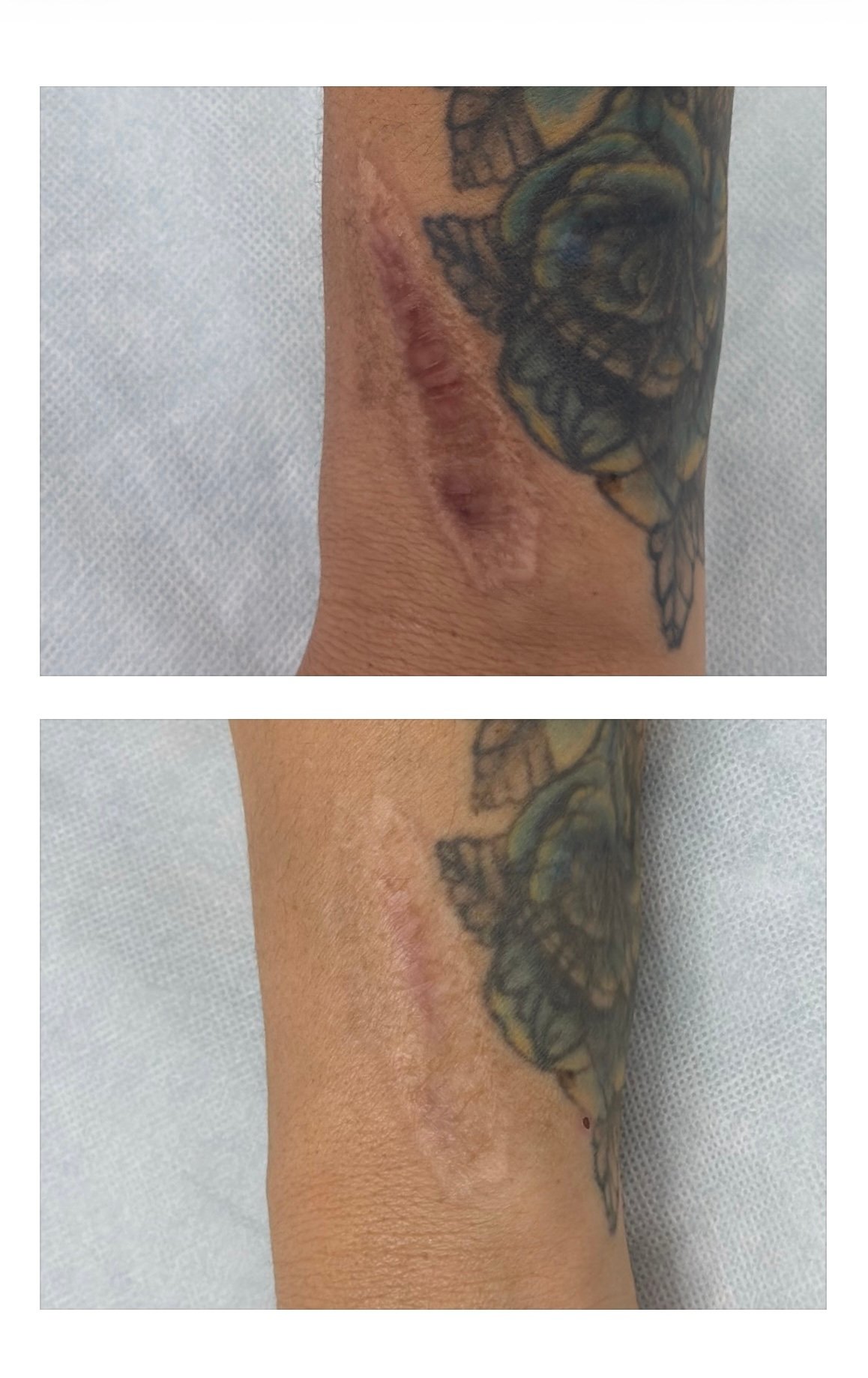 scars