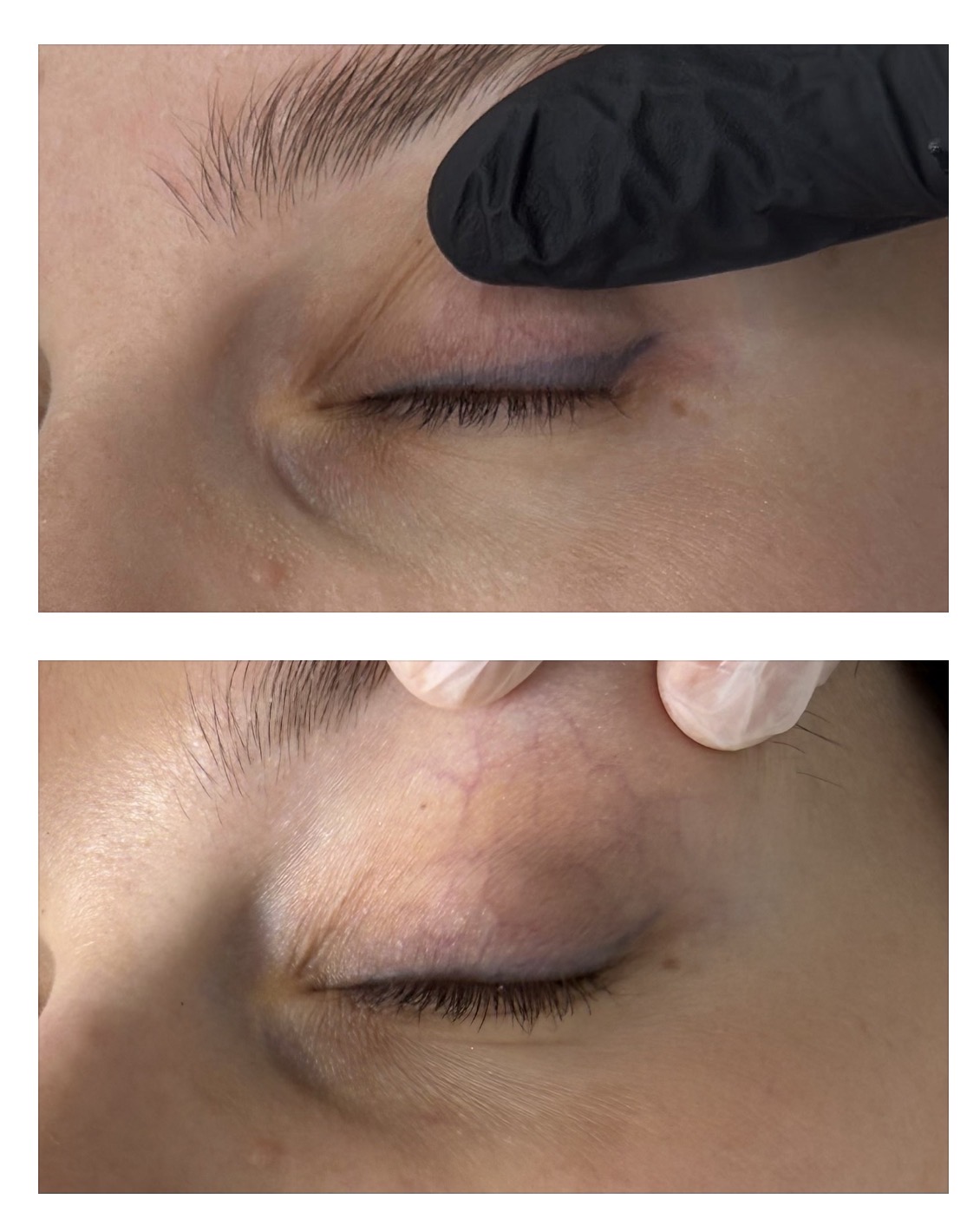 eyeliner tattoo removal