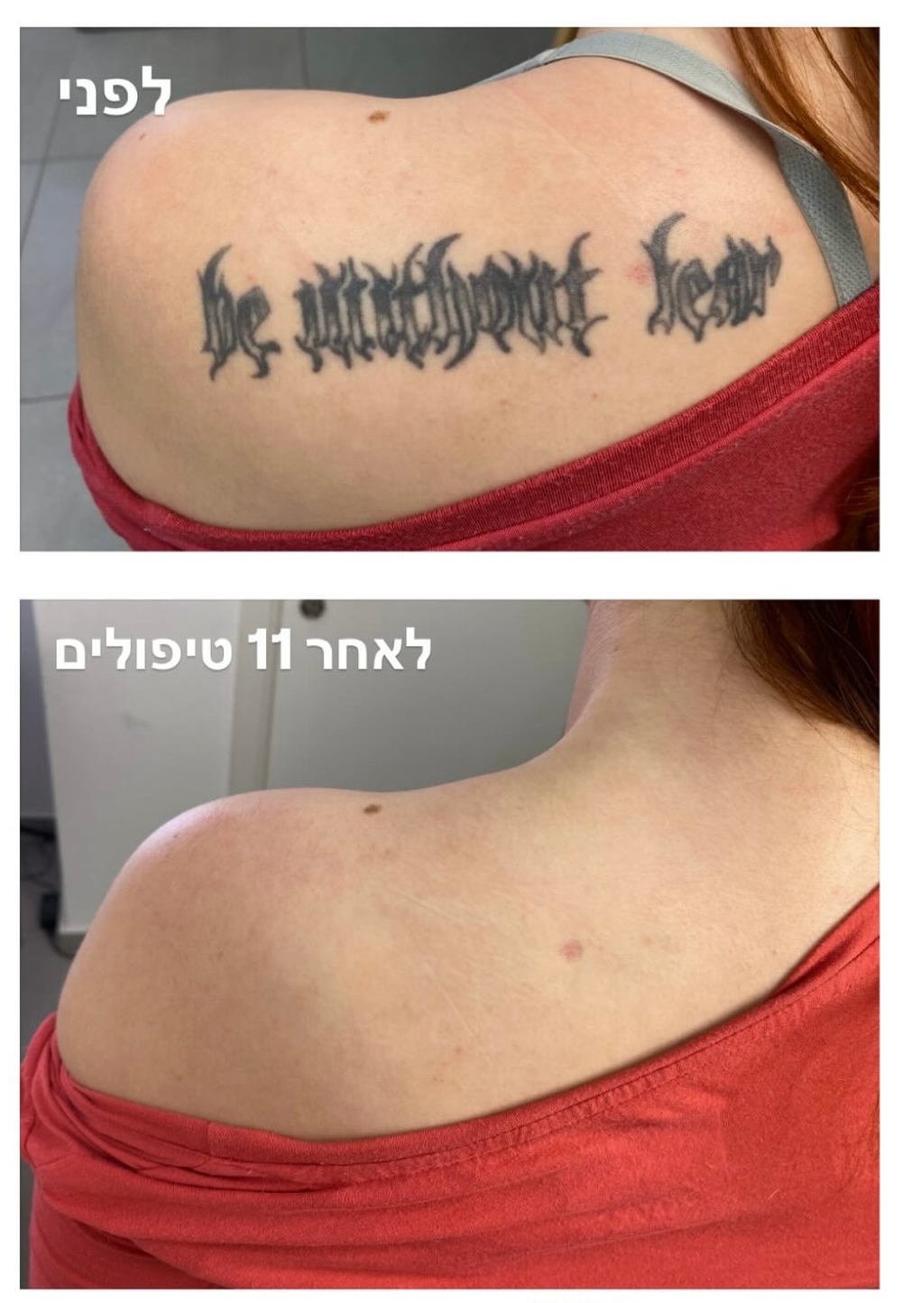 תוצאה סופית הסרת קעקועים
