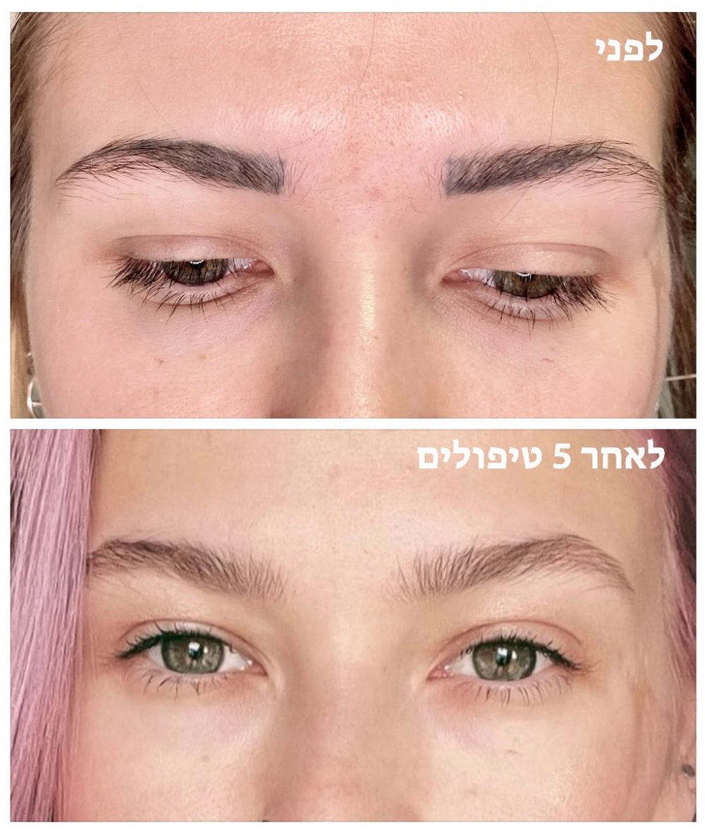 תוצאה-סופית-הסרת-איפור-קבוע-לייזר-הואס-תלאביב