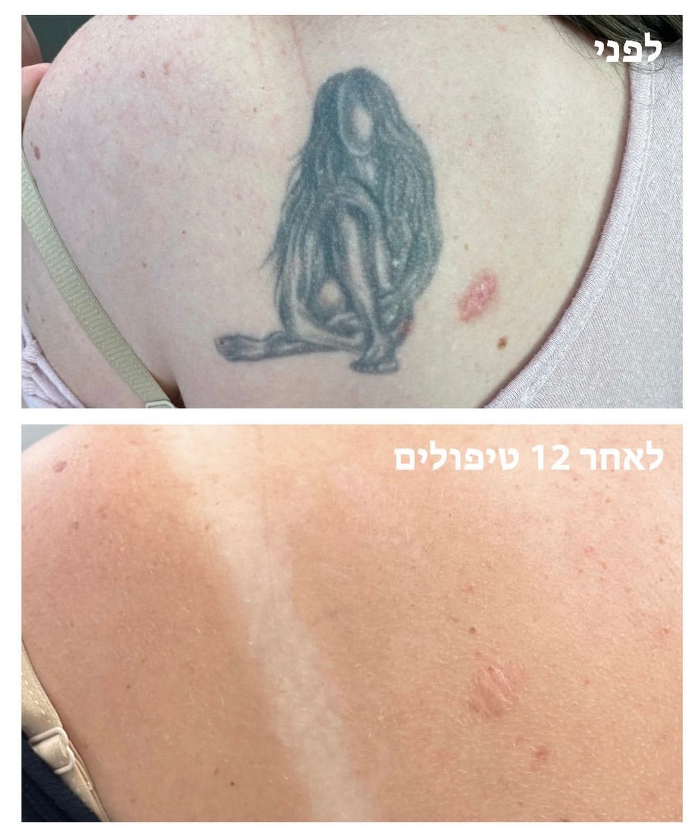תוצאה סופית הסרת קעקועים בלייזר האוס