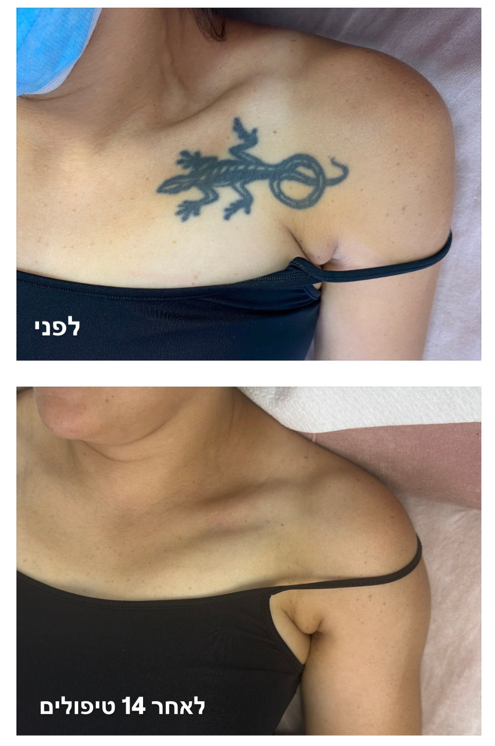 tattoo removal