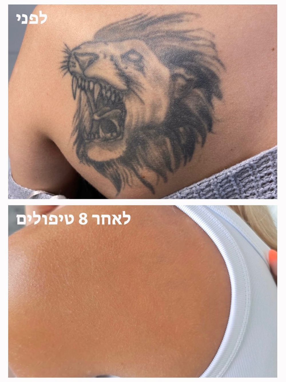 before&after tattoo removal
