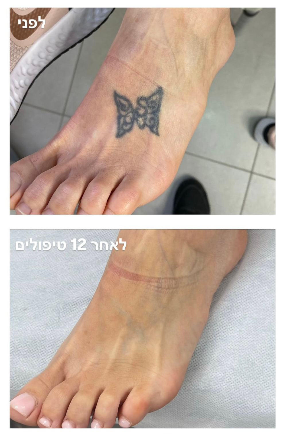 tattoo removal
