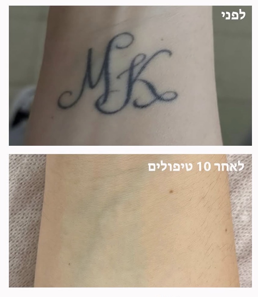 קעקוע אותיות לפני ואחרי סדרת טיפולים