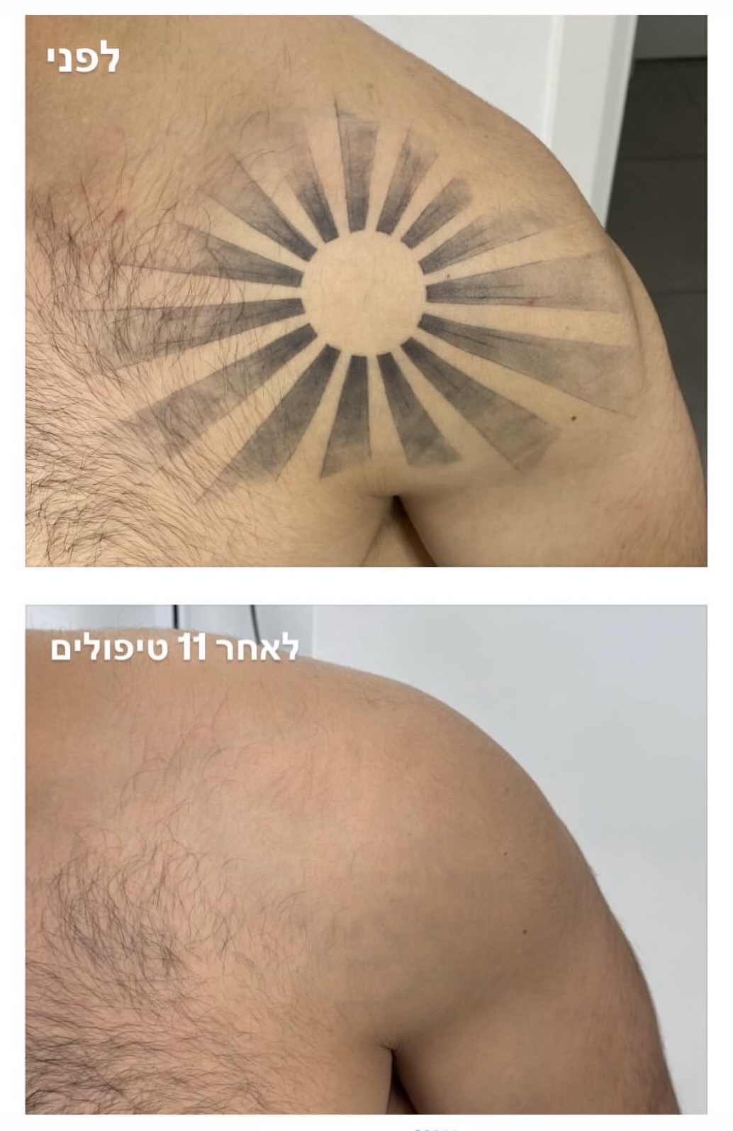 תוצאה בייני הסרת קעקועים