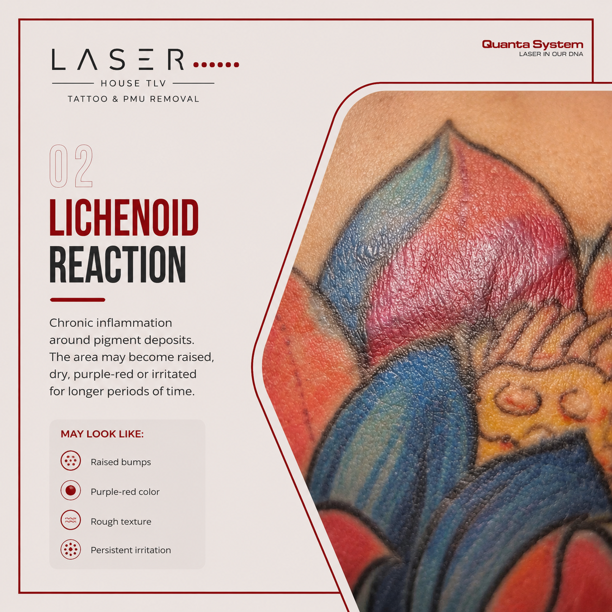 lichenoid reaction. In this type of immune response-tattoo-removal-reaction