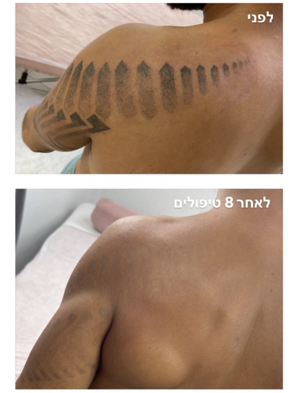 הסרת קעקועים בתהליך