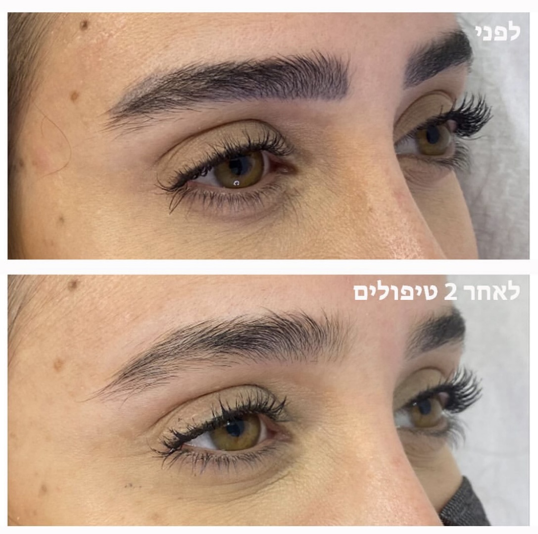 הסרת איפור קבוע בתל אביב