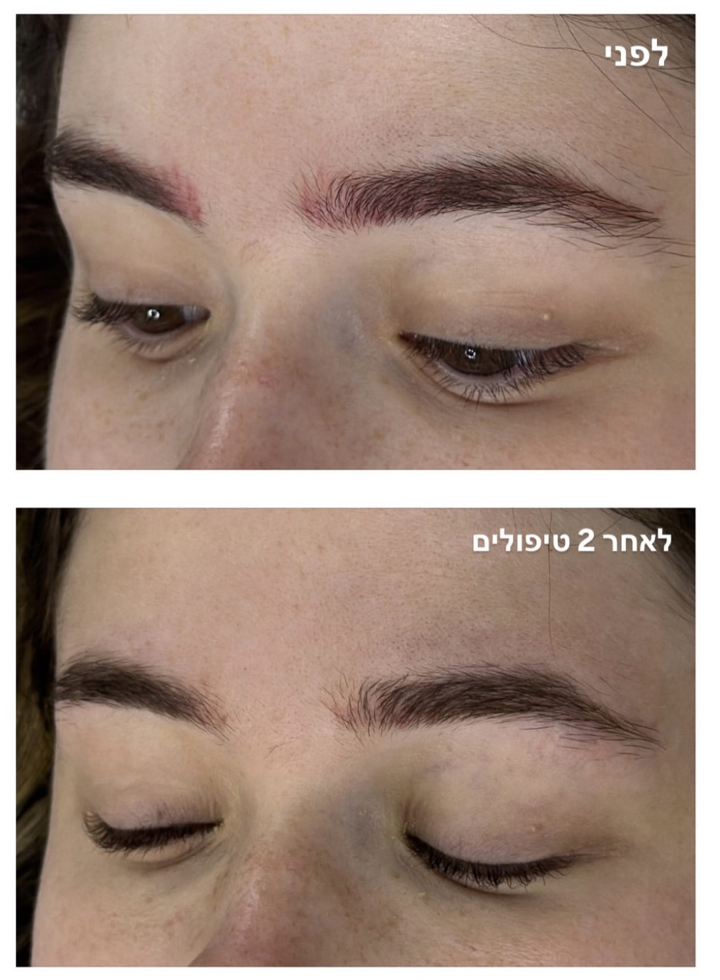 הסרת איפור קבוע גבות
