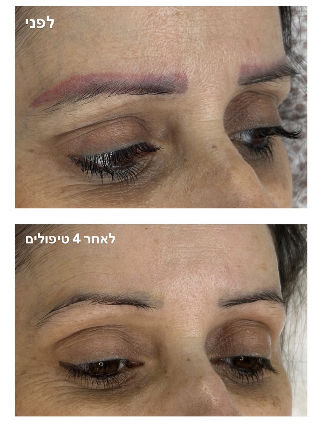 הסרת איפור קבוע מקצועי בתל אביב