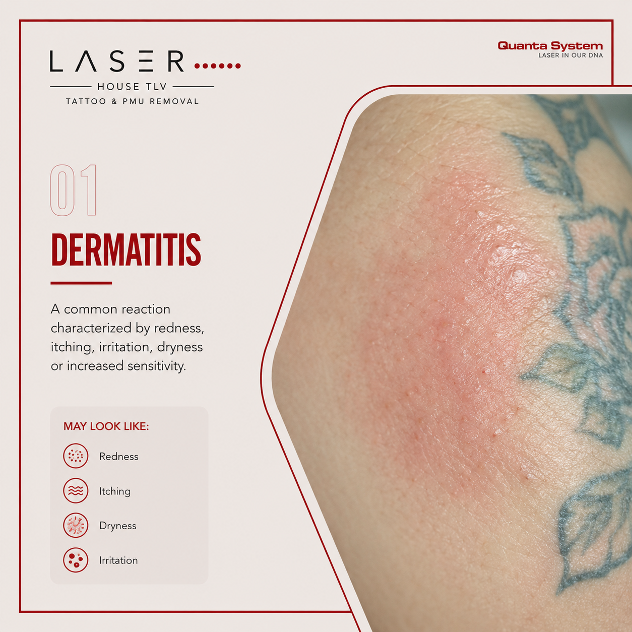 One of the most common reactions is dermatitis-tattoo-removal-reaction
