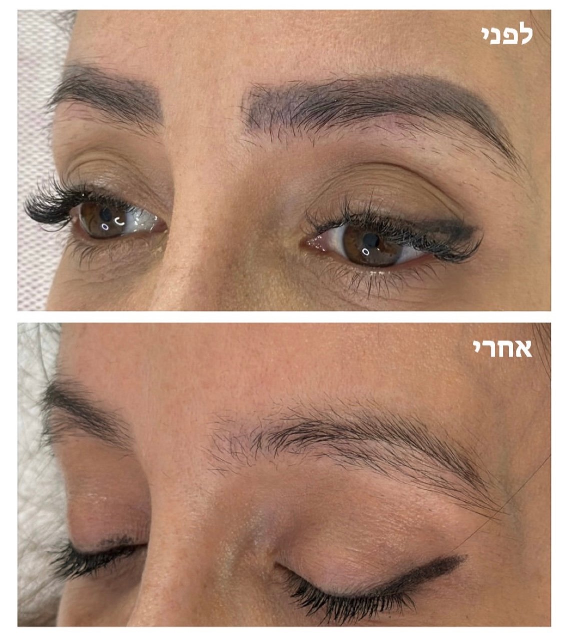 before&after tattoo removal