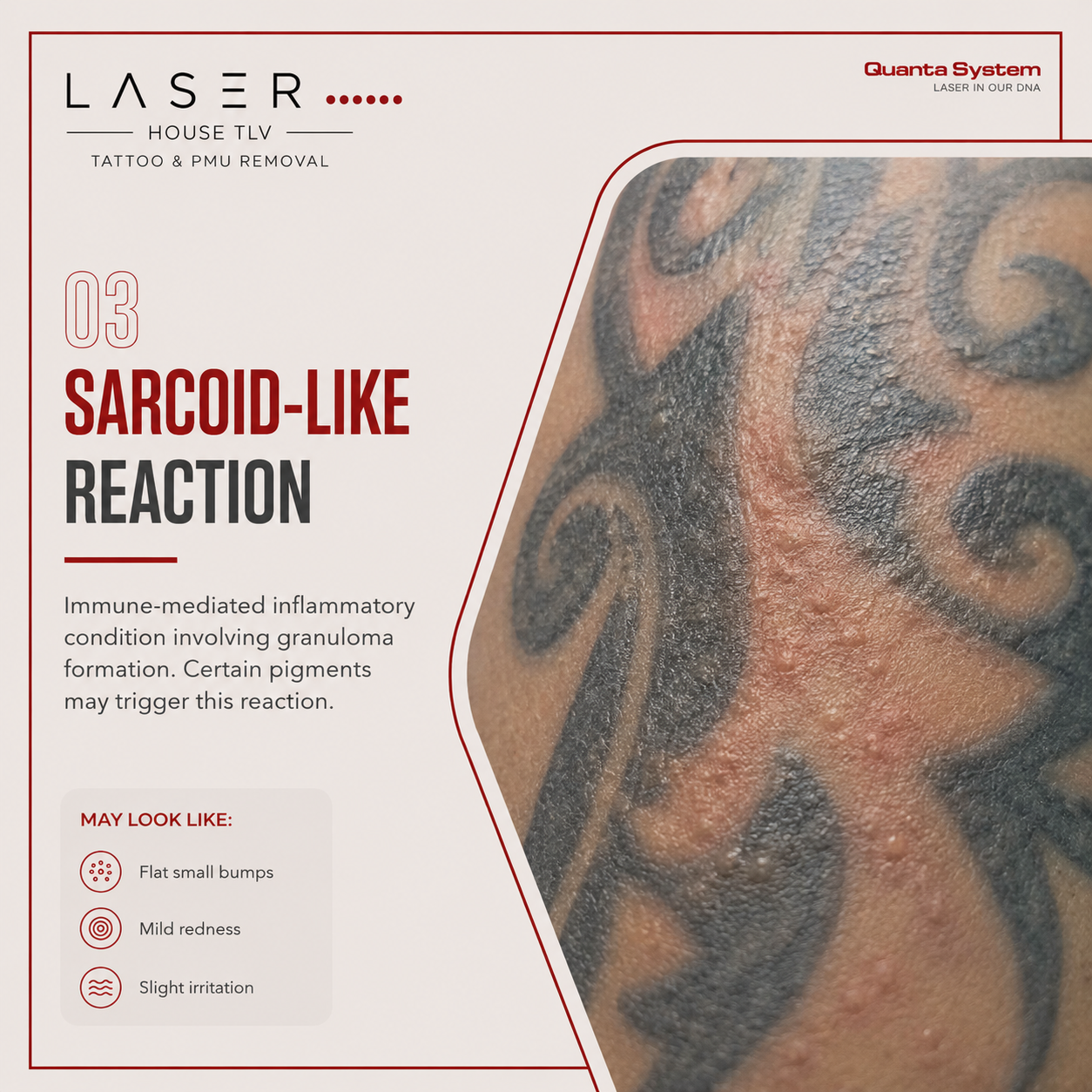 tattoo pigments may also trigger sarcoid-like reaction