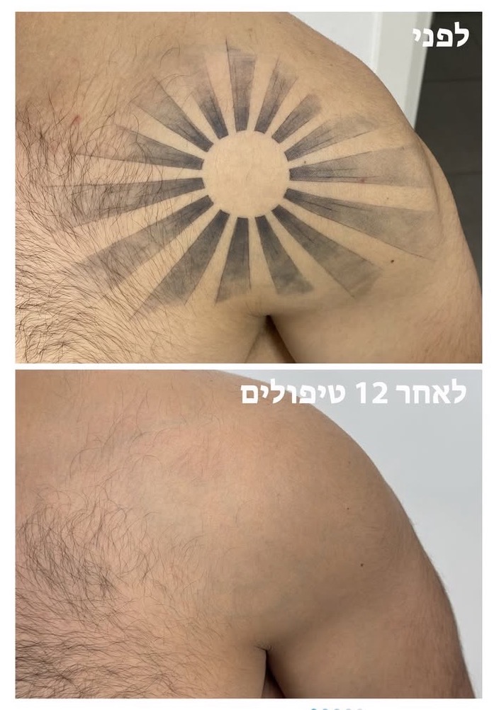 קעקוע שמש בכתף לפני ואחרי סדרת טיפולים