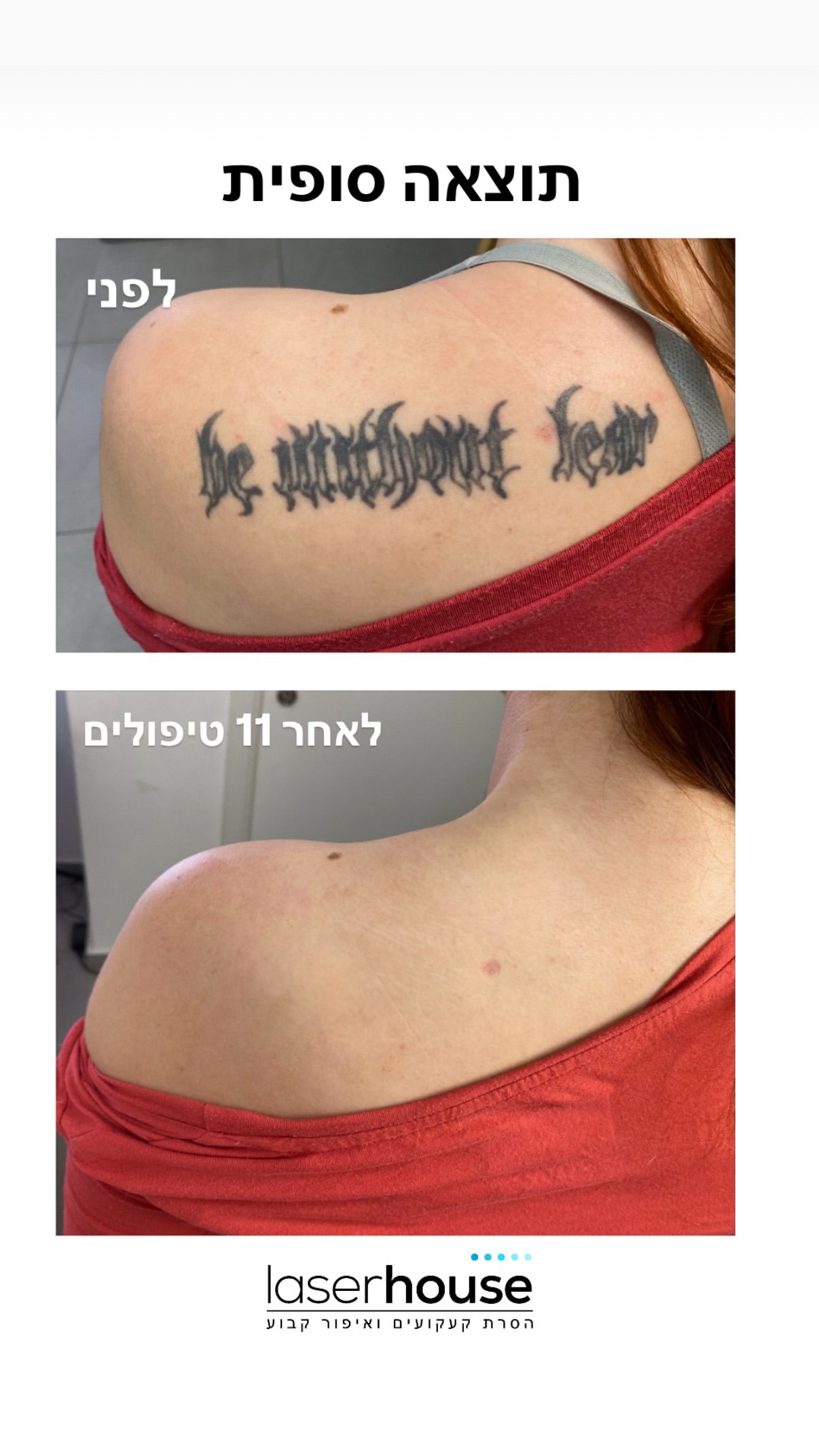 תוצאה סופית הסרת קעקועים בלייזר טלצקי